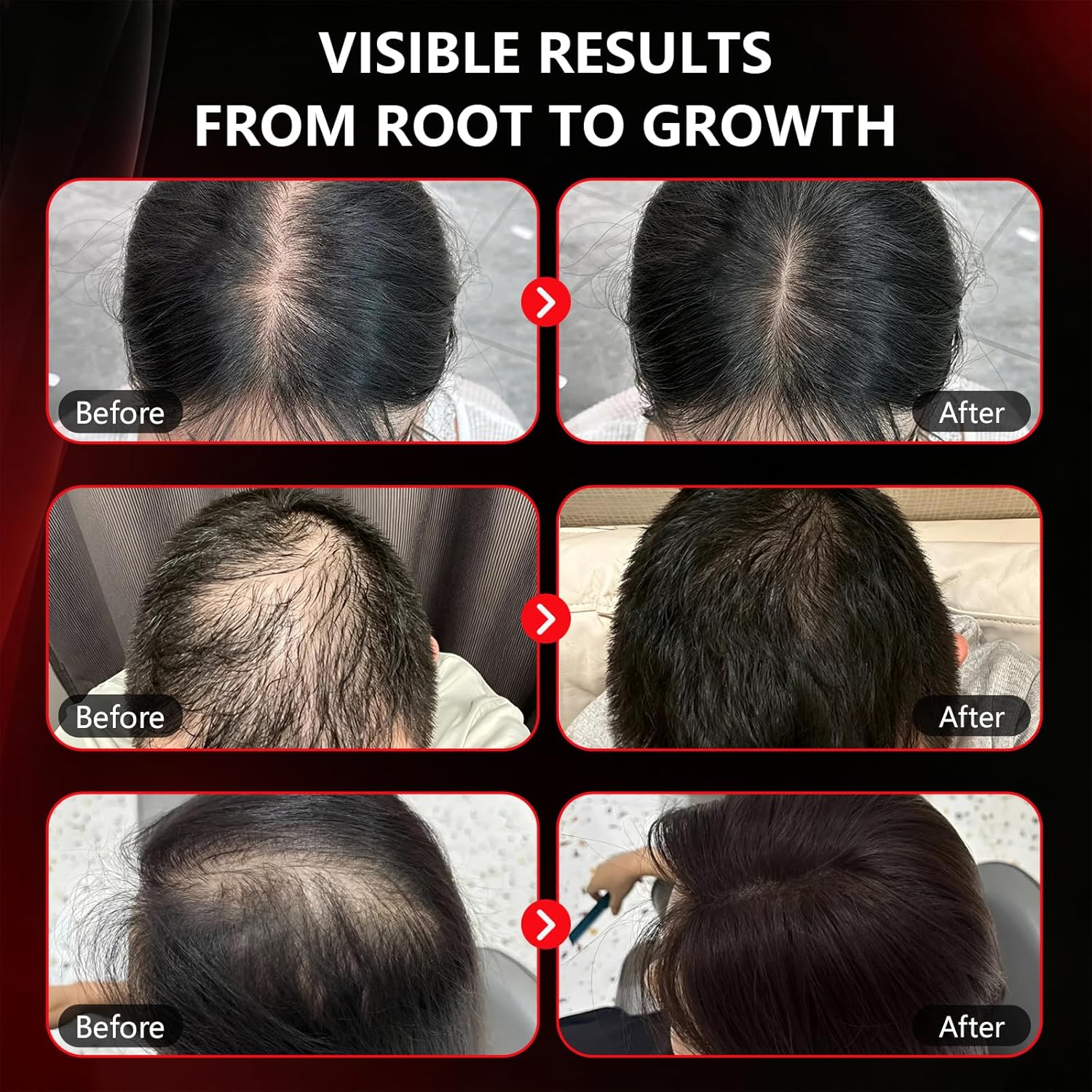 Red Light Therapy for Hair Growth Cap（High-Performance Version）